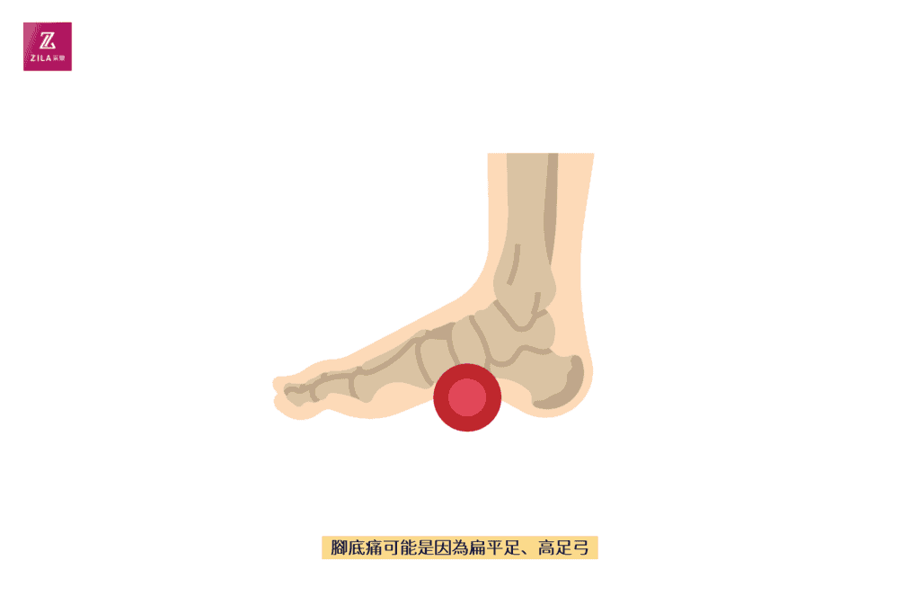 腳底痛可能是因為扁平足、高足弓